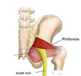 Bel Ağrısı; Priformis Sendromunda Priformis Kasının Altında Siyatik Sinir Sıkışması Bel Ağrısı; Priformis Sendromunda Priformis Kasının Altında Siyatik Sinir Sıkışması