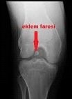 eklem faresi eklem faresi
